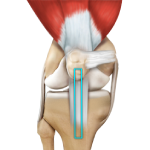 ACL Reconstruction of Patellar Tendon