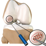 Arthroscopic Debridement