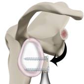 Latarjet Procedure