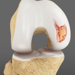 Articular Cartilage Injury