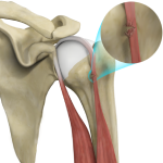 Bicep Tendon Rupture