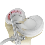 Failed Meniscus Repair