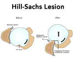 Hill-Sachs Lesion