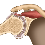 Internal Impingement of the Shoulder