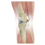 Multiligament Knee Injuries