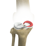 Medial Meniscus Syndrome