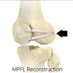 Medial Patellofemoral Ligament Reconstruction