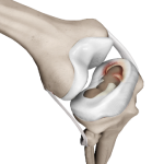 Meniscal Injuries