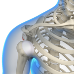 Multidirectional Instability of the Shoulder