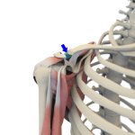 Mumford Distal Clavicle Excision