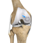 Osteochondritis Dissecans of the Knee