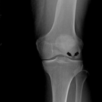 Osteonecrosis of the Knee