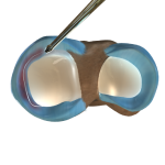 Partial Arthroscopic Meniscectomy