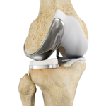 Partial Lateral Knee Replacement