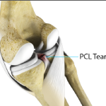 PCL Injuries