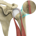 Proximal Biceps Tendon Rupture