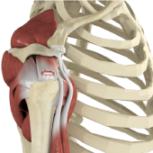 Rotator Cuff Tear