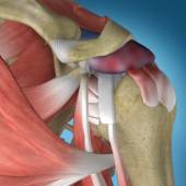 Shoulder Impingement