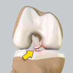 Tibial Eminence Fracture