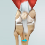 Tibial Tubercle Osteotomy