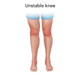 Unstable Knee