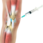 Viscosupplementation